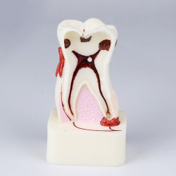 Modèle pathologique complet à dent unique