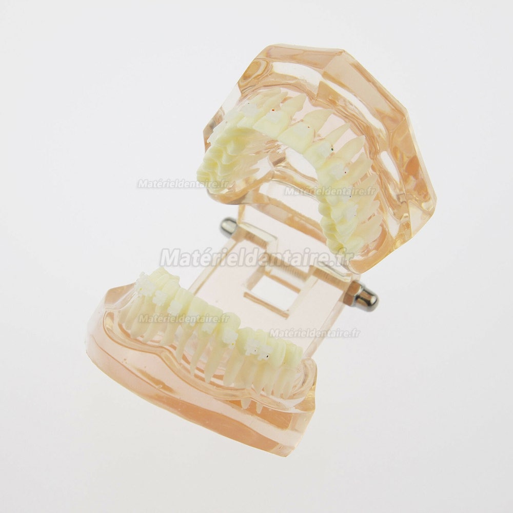 Modèle de traitement d'orthodontie dentaire dents de démonstration Bracket orthodontique en céramique 3002