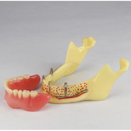 Modèle prothèse dentaire invisible M-2014b