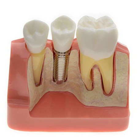 Modèle Analyse D'implant couronne dentaire M-2017