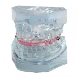 Modèle de la contention après le traitement orthodontique M-3006