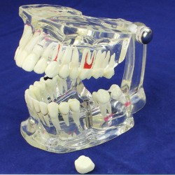 ENOVO Modèle de démonstration des maladies dentaires