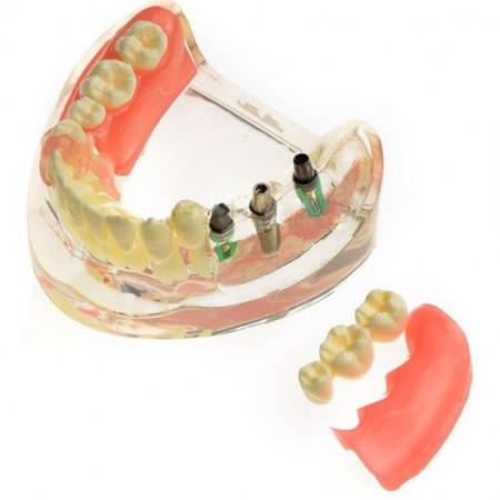 M-6006 Modèle dentaire Restauration implantaire pour molaires perdues