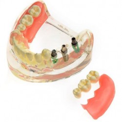 M-6006 Modèle dentaire Restauration implantaire pour molaires perdues