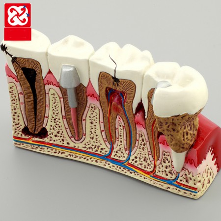 Modèle anatomique de maladie dentaire pour bureau
