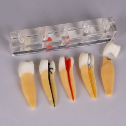 Modèle anatomique de carie dentaire