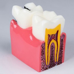 Modèle anatomique dentaire, comparaison des caries