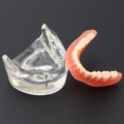 Prothèse Modèle Dentaire Couvert-dentier Inférieur avec 2 Implantations d’Étude ...
