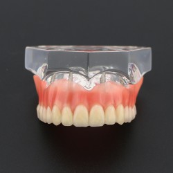 Prothèse Modèle Dentaire Couvert-dentier Inférieur avec 4 Implantations d’Étude ...