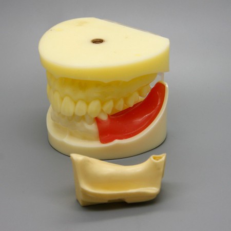 Dentaire Rose Démonstration d'analyse d'implant Modèle de maladie des dents avec restauration