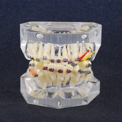 Modèle orthodontique dentaire Traitement de Malocclusion Avec crochets de chaîne...
