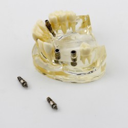 Gencive remplaçable dentaire Modèle de pratique de l'implant complet 2002