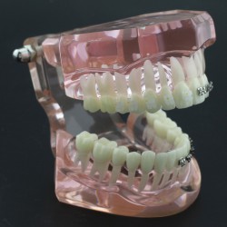 Modèle Orthodontie Contraste des brackets M3009