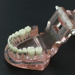 Modèle Orthodontie Contraste des brackets M3009