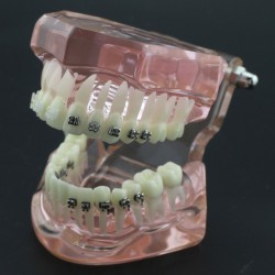 Modèle Orthodontie Contraste des brackets M3009