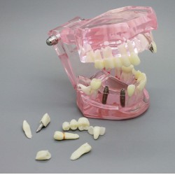 Modèle de dents de démonstration avec analyse d'étude sur implants dentaires ave...
