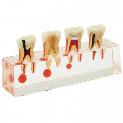 73/5000 Étude de traitement endodontique à 4 étapes de modèle de dents dentaires...