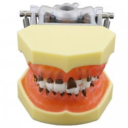 Dentaire Modèle de maladie parodontose démontre des calculs gingivés enflammés 4...