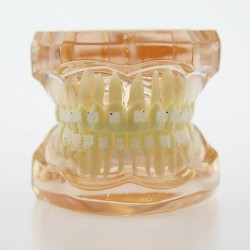 Modèle de traitement d'orthodontie dentaire dents de démonstration Bracket ortho...