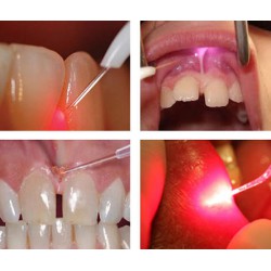 Laser à diode dentaire GaAlAs Dimed Berylas Blue 450 nm/650 nm/980 nm 0,5 W/4 W/10 W