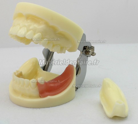 ENOVO Modèle d'exercice implant dentaire avec implant amovible