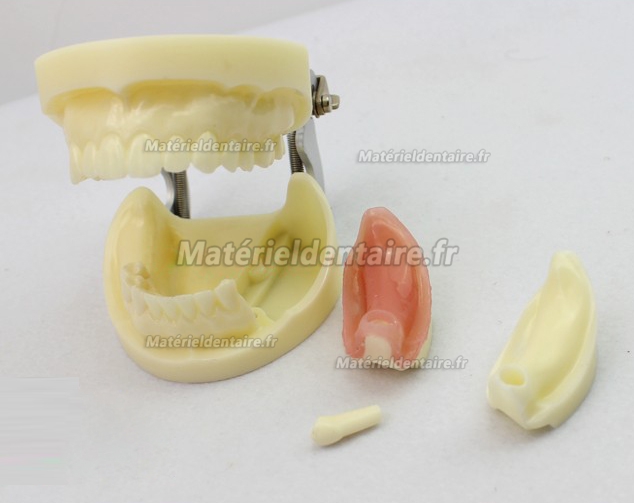 ENOVO Modèle d'exercice implant dentaire avec implant amovible