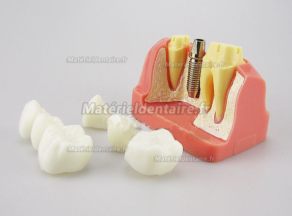 Modèle Analyse D'implant couronne dentaire M-2017