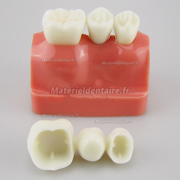 Modèle Analyse D'implant couronne dentaire M-2017