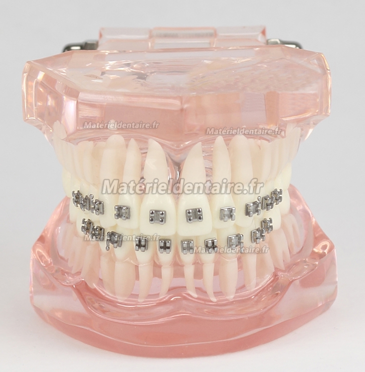 Modèle Malocclusion Correcte avec 20 Brackets M-3001