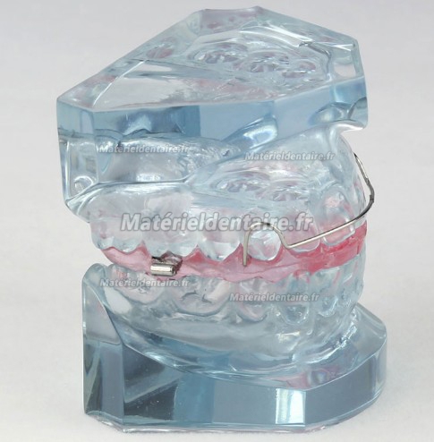Modèle de la contention après le traitement orthodontique M-3006