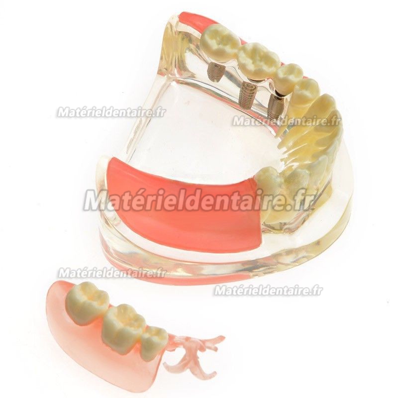 Modèle dentaire M-6006 Restauration implantaire pour molaires perdues