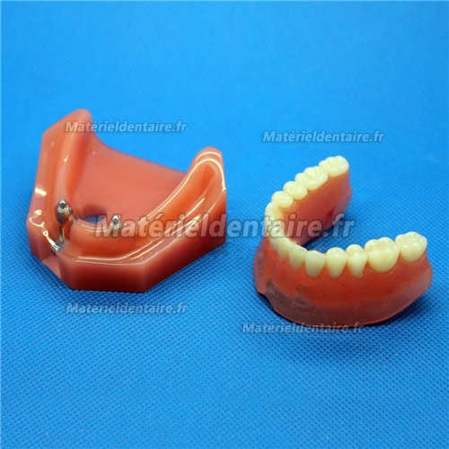 Modèle dentaire pour réparation d’implant dentaire M-6007