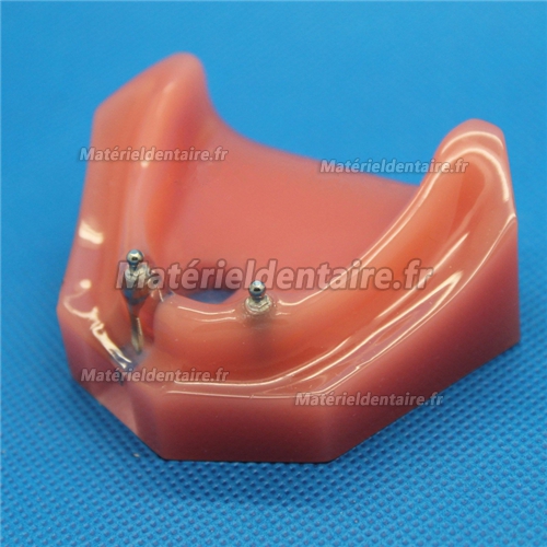 Modèle dentaire pour réparation d’implant dentaire M-6007