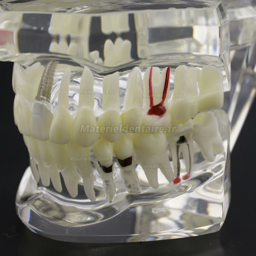 Modèle d'implant démonstration dentaire pour les maladies des dents de Caries Parodonte Rose Transparent