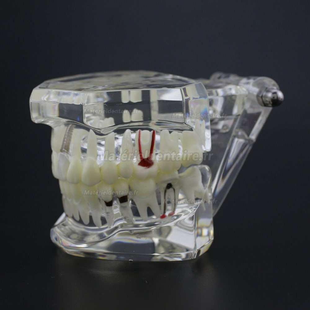 Modèle d'implant démonstration dentaire pour les maladies des dents de Caries Parodonte Rose Transparent