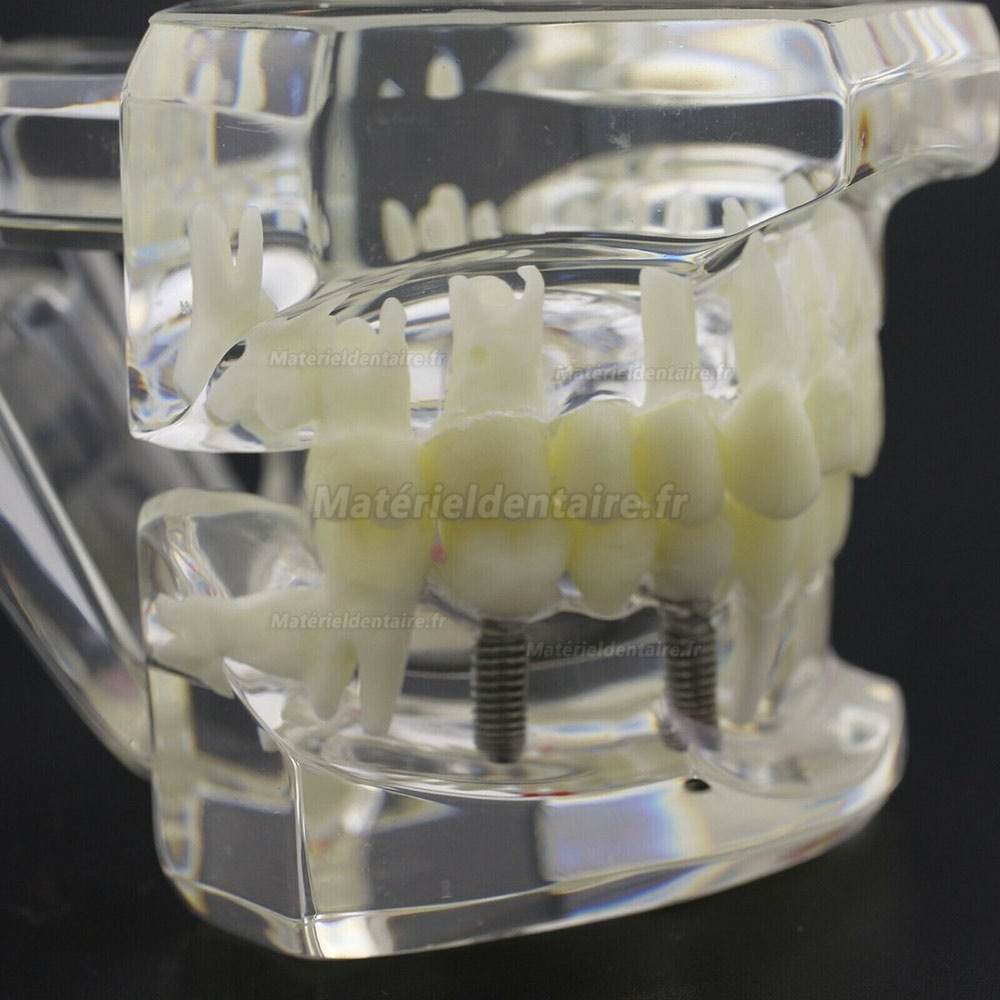 Modèle d'implant démonstration dentaire pour les maladies des dents de Caries Parodonte Rose Transparent