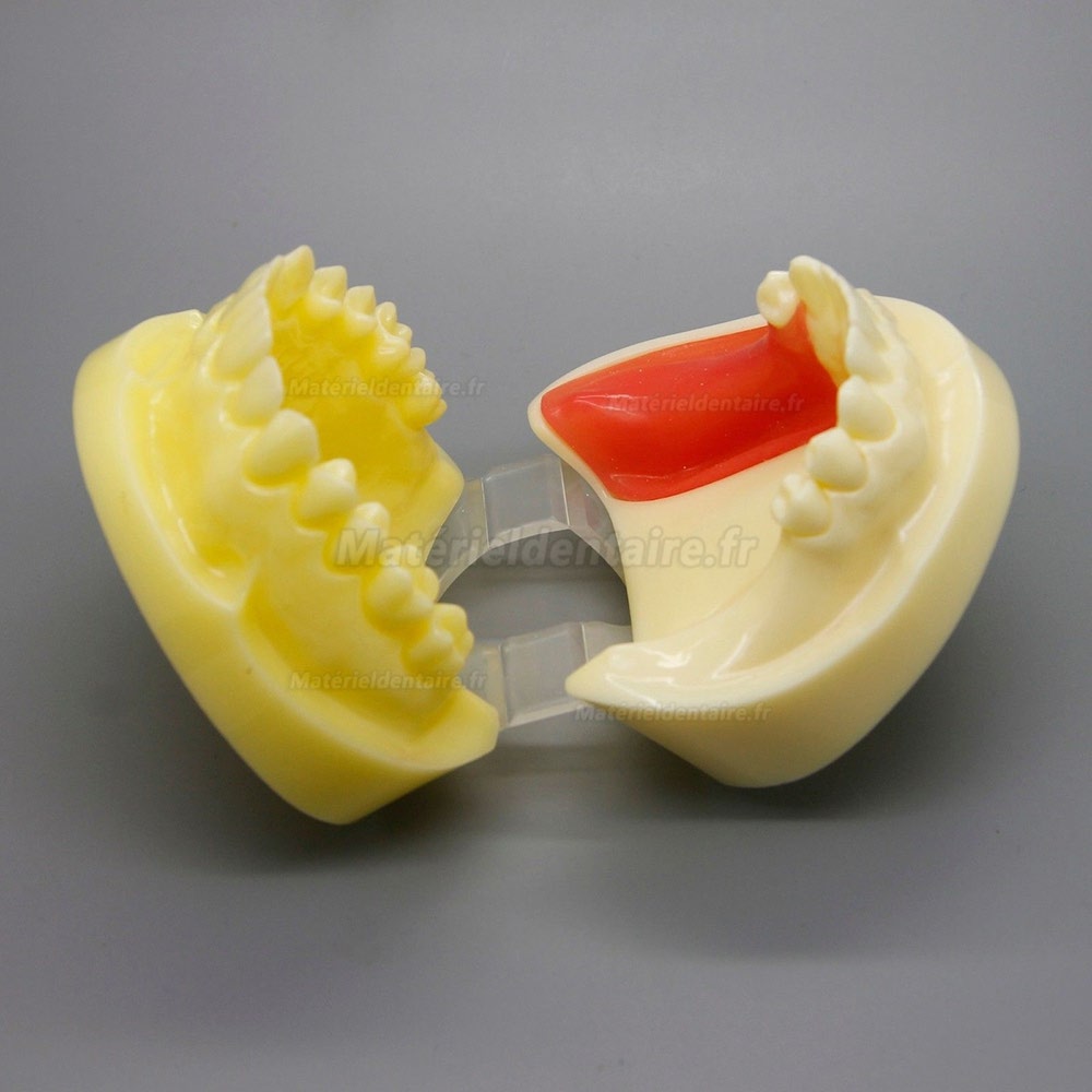 Dentaire Rose Démonstration d'analyse d'implant Modèle de maladie des dents avec restauration