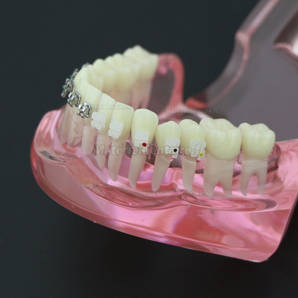 Modèle de Dents Dentaire Orthodontique Bracket métal et céramique étude 3003