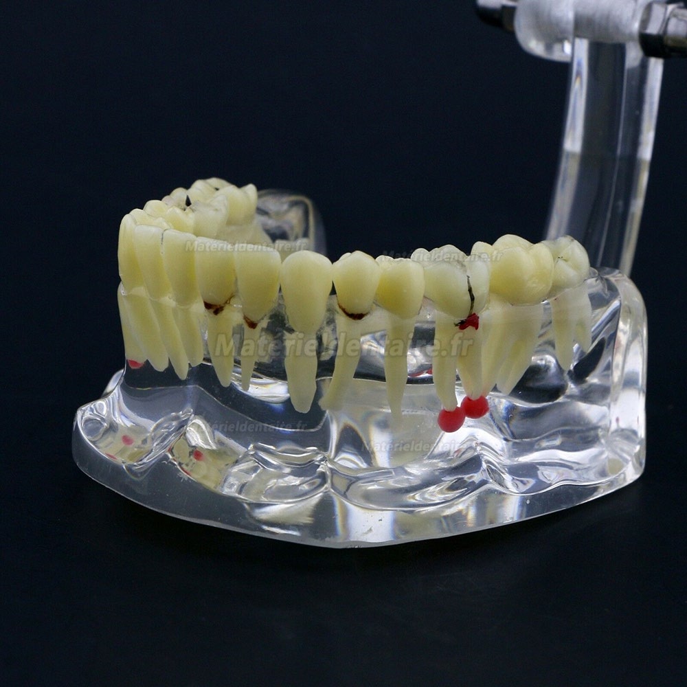 Modèle de dents #4001 pour l’étude et enseignement générale de pathologie Typodont adulte