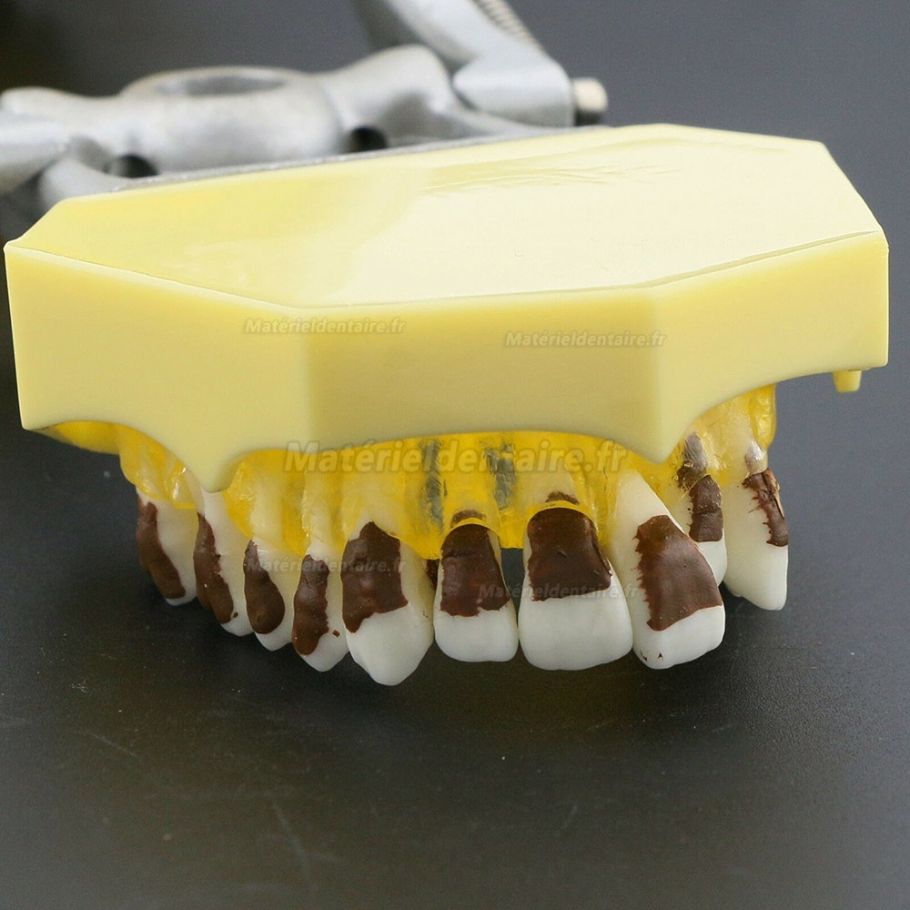 Dentaire Modèle de maladie parodontose démontre des calculs gingivés enflammés 4003