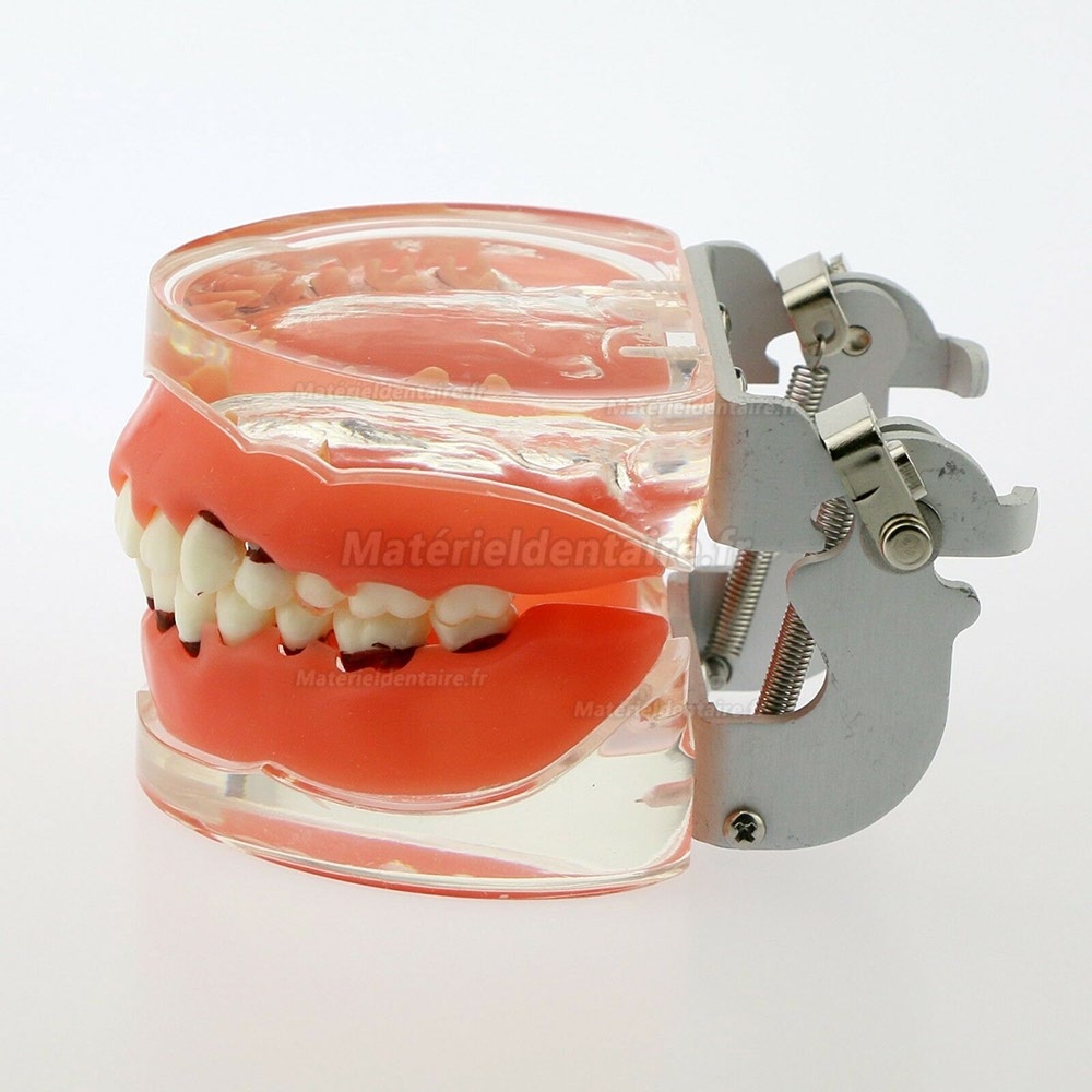 Modèle dentaire Modèle d'étude de la maladie parodontale pathologique chez l'adulte 4017