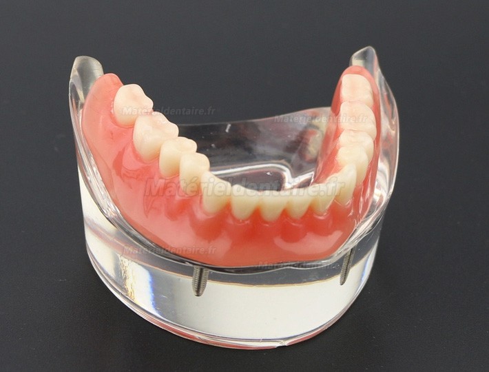 Prothèse Modèle Dentaire Couvert-dentier Inférieur avec 2 Implantations d’Étude de Démo Modèle 6002 01
