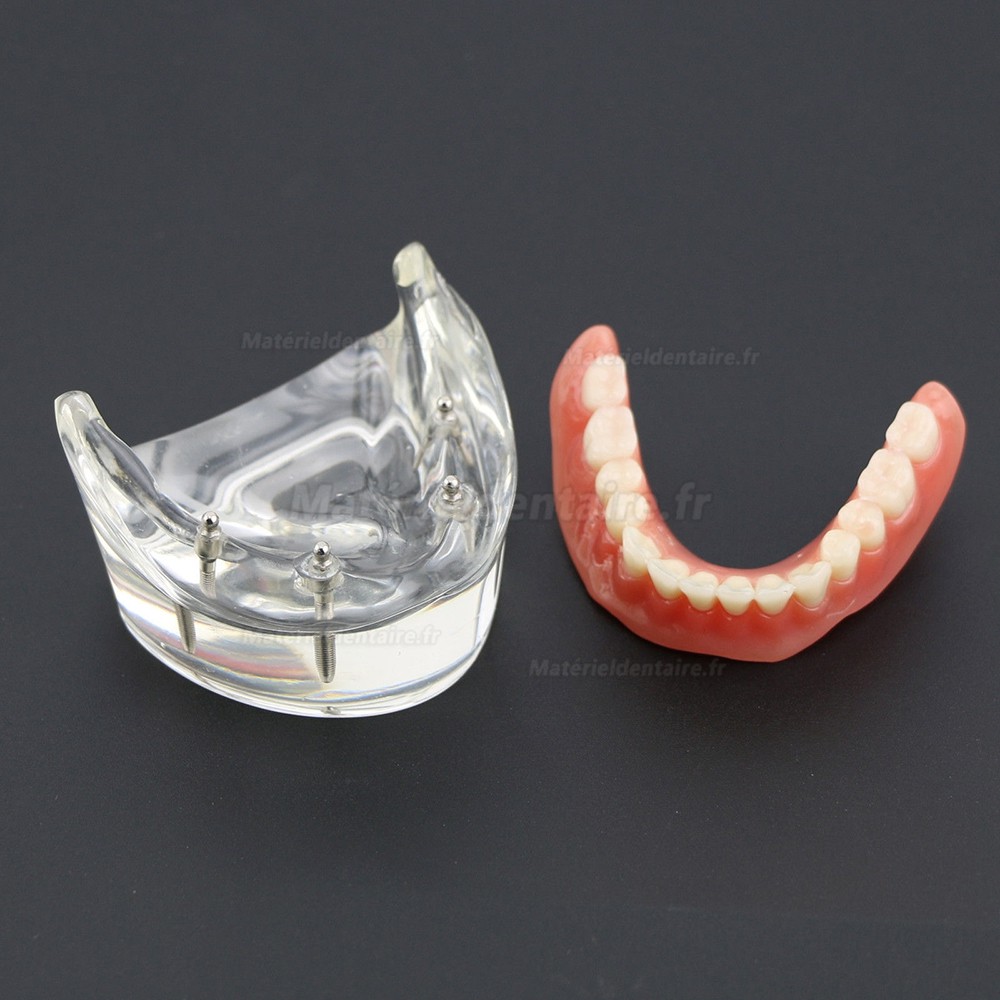 Modèle 6002 02 d’Overdenture Inférieure d’Étude de Démo de Dents Inférieures avec 4 Implants