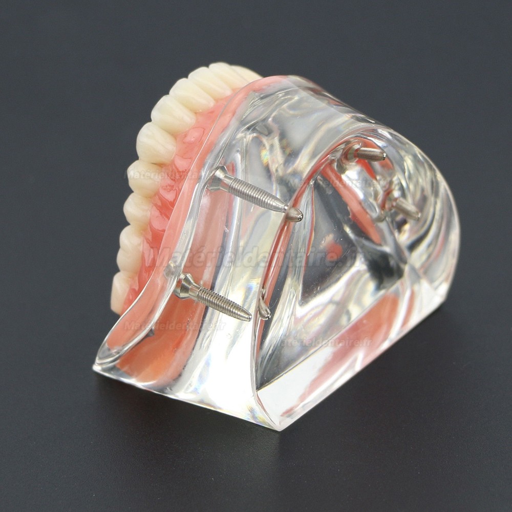 Modèle 6002 02 d’Overdenture Inférieure d’Étude de Démo de Dents Inférieures avec 4 Implants