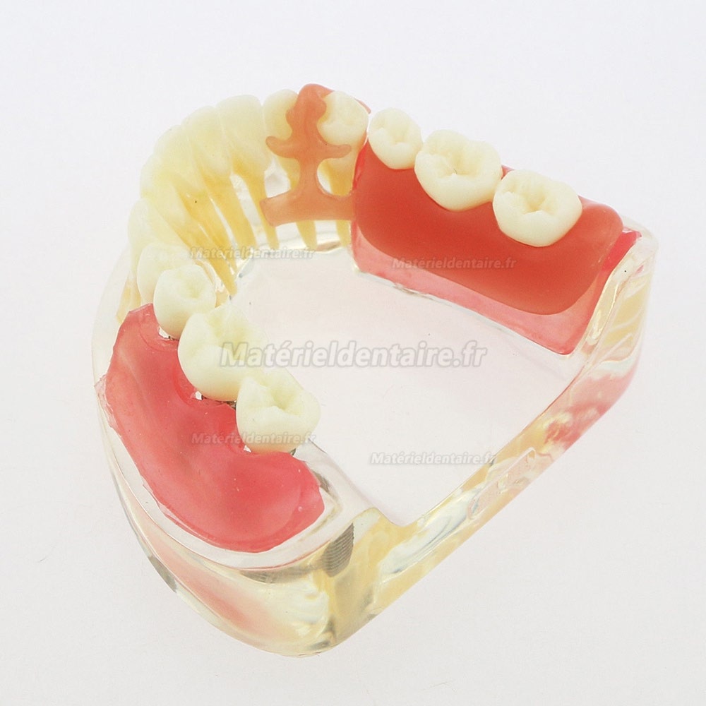 Modèle de démonstration de pont amovible d'implant de restauration de modèle de dents inférieures dentaires 6006