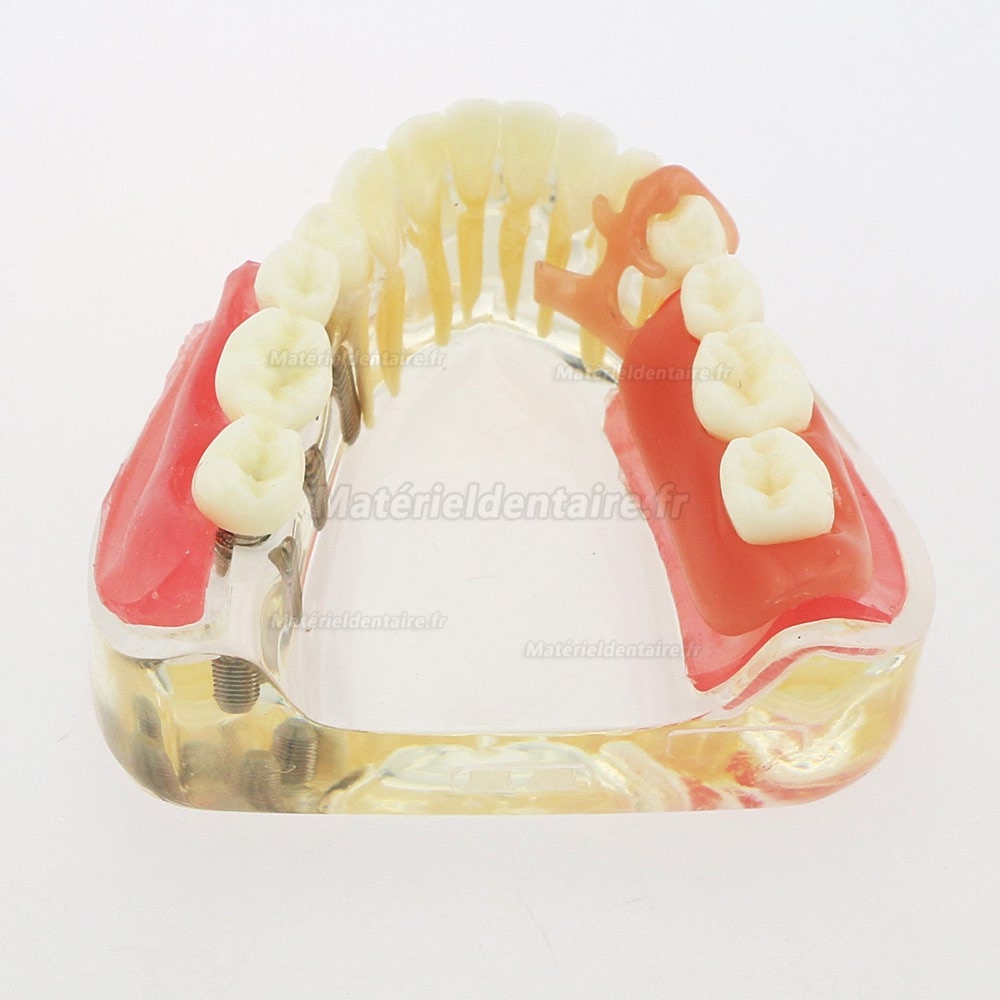 Modèle de démonstration de pont amovible d'implant de restauration de modèle de dents inférieures dentaires 6006