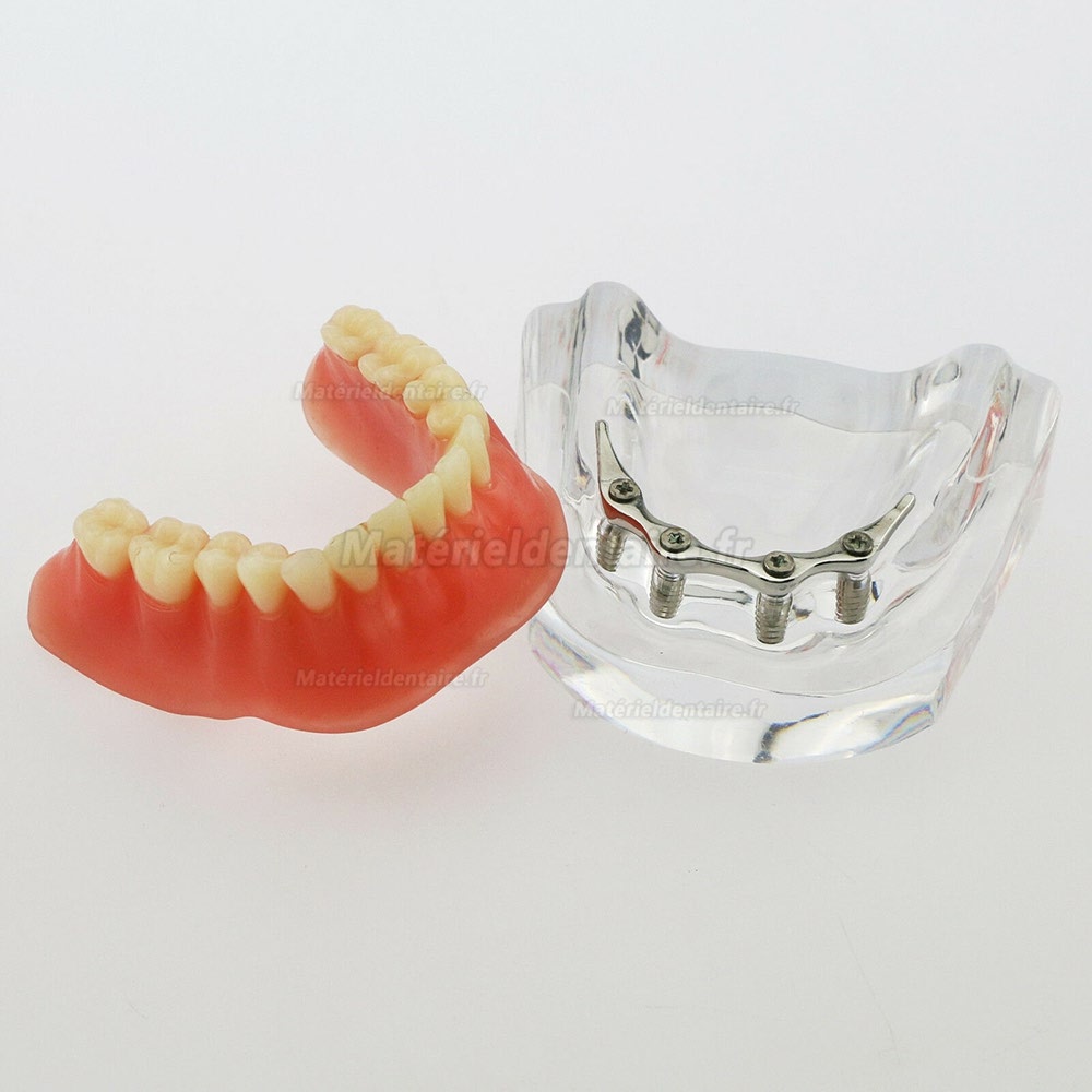 Dentaire inférieur Modèle de dents Overdenture Précision 4 implants Manifestation Bar d'Argent