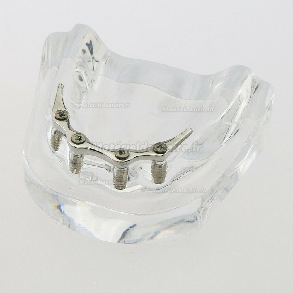 Dentaire inférieur Modèle de dents Overdenture Précision 4 implants Manifestation Bar d'Argent