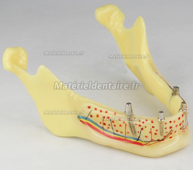 Modèle prothèse dentaire invisible M-2014b