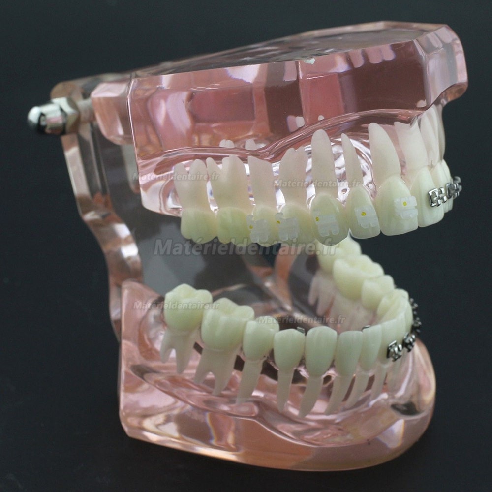 Modèle Orthodontie Contraste des brackets M3009